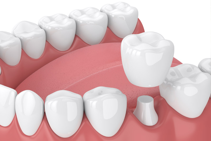 Dental Crowns in Yardley