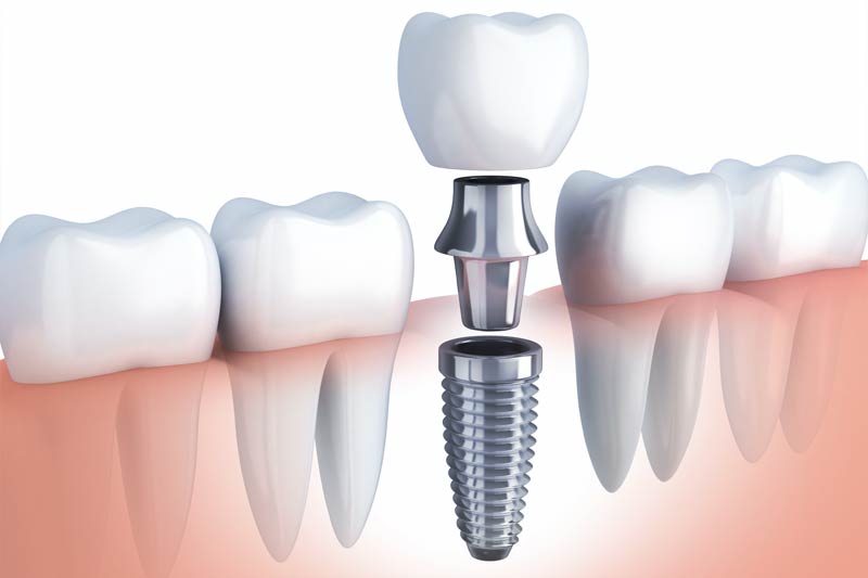 Implants Dentist in Yardley