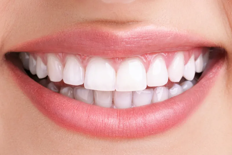 After Teeth Photo